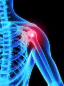 shoulder Ability Rehabilitation